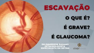 O que é escavação do nervo  Dr Emmerson Badaró  Viver oftalmologia [upl. by Anurb498]