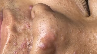 ACNE TREATMENT VU QUYNH MI  Blackheads Chin amp Nose Of Tweens 2024 [upl. by Clinton]