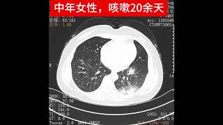 肺隐球菌病Pulmonary cryptococcosis [upl. by Trin]