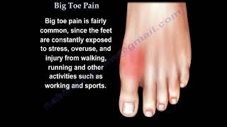 Big Toe Pain  Everything You Need To Know  Dr Nabil Ebraheim [upl. by Yrogerg]