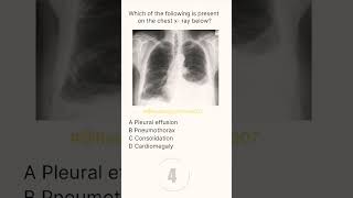 Chest XRay Buzz 7 radiologychannel007 [upl. by Ujawernalo]