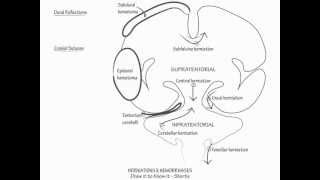 Herniation amp Intracranial Hemorrhage  Draw it to Know it Neuroanatomy [upl. by Natfa573]