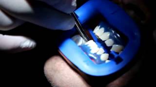 How is Laser Teeth Whitening Done  Teeth whitening in Toronto [upl. by Leonteen824]