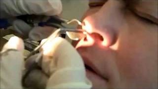 WORLDS BIGGEST BOOGER PULLED OUT OF NOSE DISTURBING [upl. by Cele]