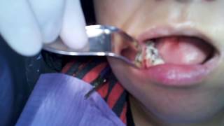 Portland OR Dentist Pain Free Tooth Extraction Video [upl. by Apoor411]