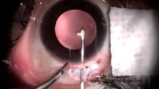 Nanophthalmos 2nd eye IOL surgery [upl. by Revned]