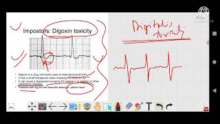 ecg digoxin digitalis toxicity [upl. by Mcspadden]