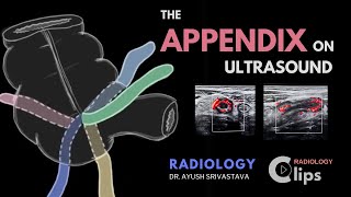 The Appendix on ultrasound and Acute appendicitis  Radiology [upl. by Muriel]