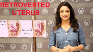 RETROVERTED UTERUS  वाली LADIES  को PREGNANT  होने में क्या PROBLEM  आ सकती हैं [upl. by Airtina]