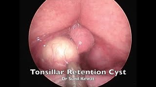 Tonsillar Retention Cyst  Incision and Drainage  Dr Sunil Kewat [upl. by Sillaw]