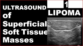 Lipoma on Ultrasound [upl. by Orofselet]