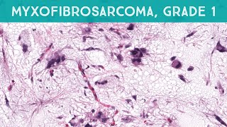 Myxofibrosarcoma grade 1low grade explained in 5 minutes dermpath dermatology sarcoma pathology [upl. by Llesram143]