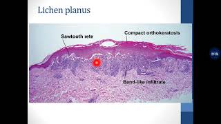 Basic Dermatopathology 7 Interface  Lichenoid [upl. by Laeynad]