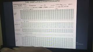 Partograph case study [upl. by Nivat]