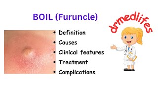 Boil furuncle definition causes clinical features treatment complications [upl. by Elac]