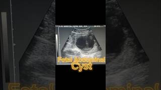 Anomaly Scan  Anomaly Ultrasound  Fetal Cyst  Oligohydramnios on Ultrasound [upl. by Etana157]