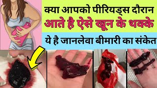 Period Me Blood Clots Aana नार्मल है Period Me Blood Ka Thakka Aana  Blood Clots During Period [upl. by Aliekahs]