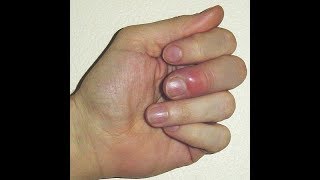 How I handle infected finger  paronychia [upl. by Glanti]