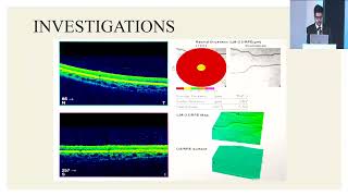 AIOC2024 GP199 topic Dr Markandeya Singh Foveal Aplasia [upl. by Ardnad]