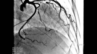 Coronary angiography views  coronary projections for left and right coronary arteries [upl. by Hermes]