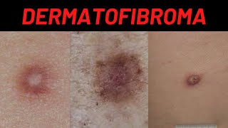 Dermatofibroma Causes Symptoms What is it How is it treated Benign Fibrous Histiocytoma [upl. by Bathelda]