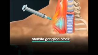 stellate ganglion block [upl. by Mcgraw]