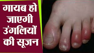 सर्दियों में उँगलियाँ सूजने का Homeopathic इलाज  Chilblains  Swollen hands amp fingers in Winter [upl. by Anaj261]