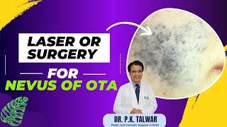 Laser or Surgery for Nevus of ota  Best Treatment Options by Dr PK Talwar [upl. by Cummings]