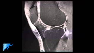 How to Read Knee MRI of Meniscal Root Tear  Knee Surgery Recovery Time  Minneapolis St Paul MN [upl. by Cowey]