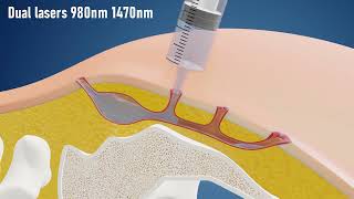 Sinus Laser Ablation Of Pilonidal Cyst SILAC  IBI Healthcare Institute [upl. by Acihsay]