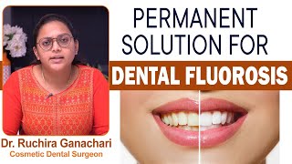 Causes Of Dental Fluorosis  Best Dental Fluorosis Treatment  Oral Care  Eledent Dental Hospitals [upl. by Dorinda]