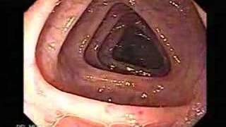 Endoscopia del Colon Colonoscopia [upl. by Atiuqer]