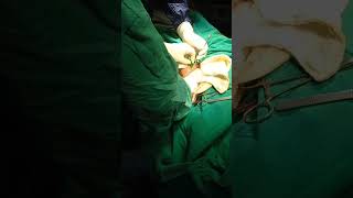 Open surgery small amount of sludge in gb bilateral adnexal cyst  minimal free fluid in petronium c [upl. by Previdi]