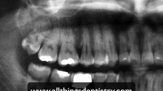 3rd Molar Extractions  Maxillary Molar Apices [upl. by Jabe]