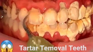 Tartar Removal Teeth 2024 001 [upl. by Ronen]