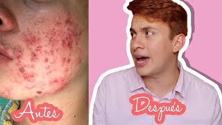 CÓMO ELIMINAR CICATRICES DE ACNE  Estas son las cremas que use  –Heeysoycesar [upl. by Eyak]