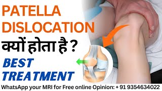 Patella Subluxation Dislocation क्यों होता है  MPFL Injury Causes amp Best Treatment [upl. by Llyrad]