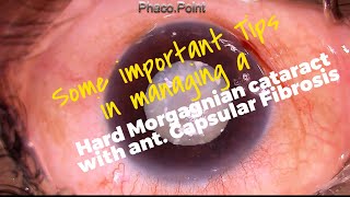 Some Important Tips in managing a Hard Leathery Morgagnian Cataract with a Fibrotic Anterior Capsule [upl. by Etnod]