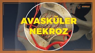 AVASKÜLER NEKROZ TEDAVİLERİ [upl. by Ahsetra162]