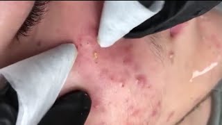 Treating Acne  Blackhead  Blackhead Removal on forehead  Remove Blackhead [upl. by Antonius270]