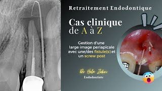 Retraitement endodontique Cas Clinique de A à Z fistule screw post obturation et controle [upl. by Abibah]