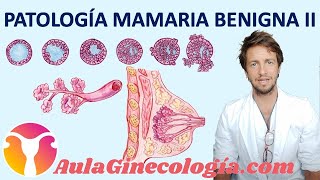 PATOLOGÍA BENIGNA DE LA MAMA II FIBROADENOMA PAPILOMA HIPERPLASIA  Ginecología y obstetricia [upl. by Ylrebnik]