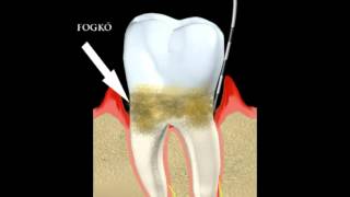 Fogkőeltávolítás a fogínysorvadás megelőzése [upl. by Cida]