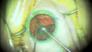 Routine Cataract Surgery  Narrated [upl. by Panchito]