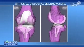 Artrosi al ginocchio una nuova cura [upl. by Nauqat]