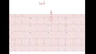 R wave part 3  Reading EKG video 10 [upl. by Wye]