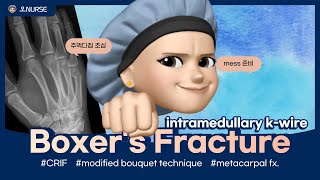 CRIF5th metacarpal fractureintramedullary kwire [upl. by Kra]