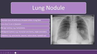 Lung Nodules and Bronchiectasis on Chest Xray radiology [upl. by Assiar]