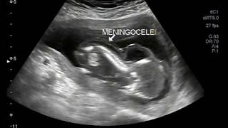 Ultrasound Video showing intrauterine death of fetus with encephalocele and meningocele [upl. by Jeannie]