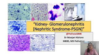 Glomerulonephritis 1 Nephritic Syndrome PSGN [upl. by Mcnully410]